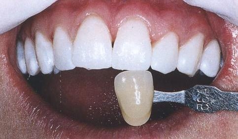 Революционная методика отбеливания зубов ZOOM. Отсутствие противопоказаний и высокий эффект отбеливания. Здоровье